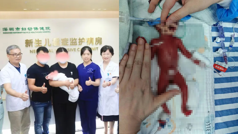 深圳「巴掌BB」胎龄23周出生仅重330克，经105天抢救出院刷新超早产儿救治纪录。