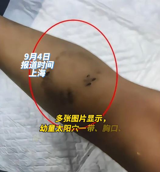 上海有3歲半男孩被虐打至腦死昏迷。