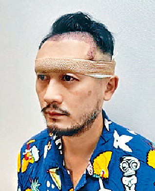 ■Aaron唔覺尷尬,主動公開早前做植髮手術。 ■Aaron唔覺尷尬,主動公開早前做植髮手術。