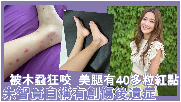 朱智賢慘被木蝨狂咬，雙腳滿是紅點。