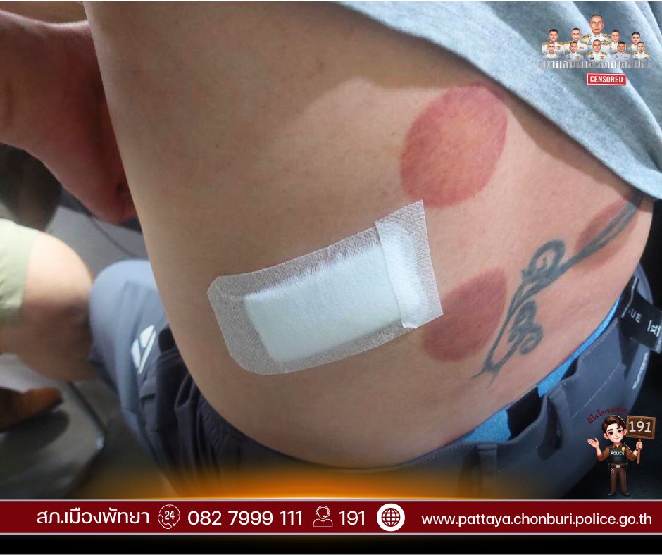 受害人傷勢。facebook / สภ.เมืองพัทยา