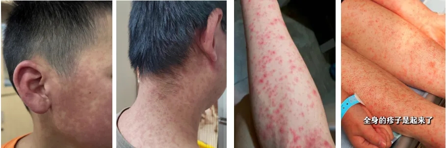 基孔肯雅熱紅疹症状。 基孔肯雅熱紅疹症状。