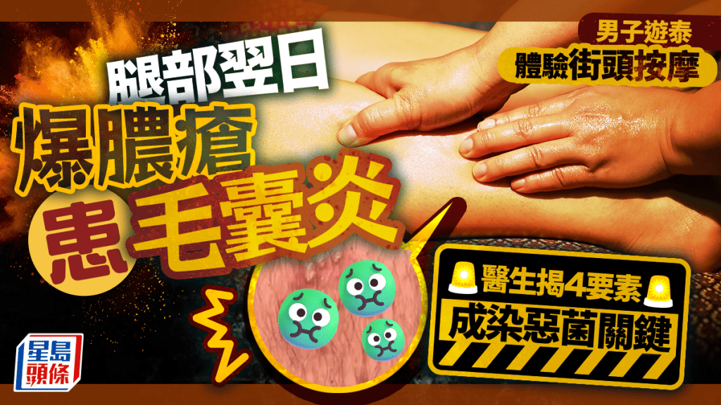 男子遊泰體驗街頭按摩 腿部翌日爆膿瘡患毛囊炎 醫生揭4要素成染惡菌關鍵