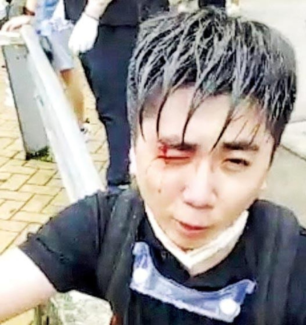 杨子俊在2019年6月21日的金钟冲突中右眼受伤。网图