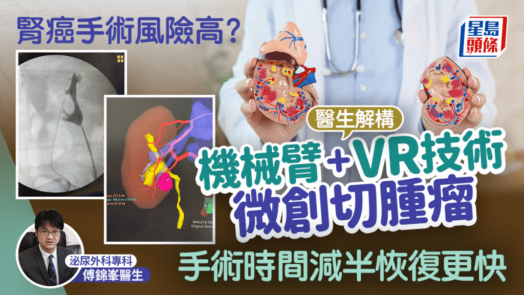  肾癌手术风险高？医生解构机械臂+VR技术微创切肿瘤 大幅缩减手术时间康复更快