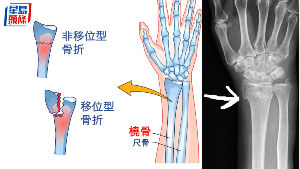橈骨骨折少兒最常見。網上圖片