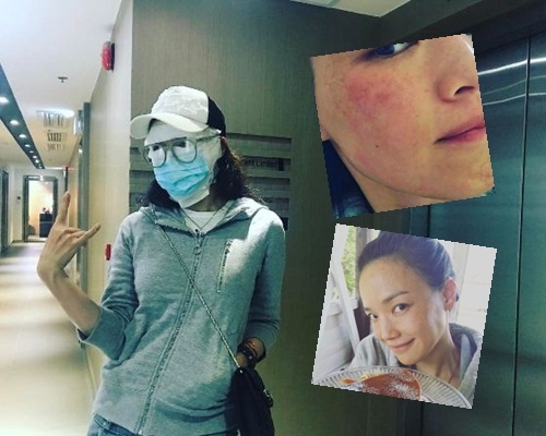 舒淇因皮膚過敏睇醫生,包到似木乃伊出街還懂得自娛。