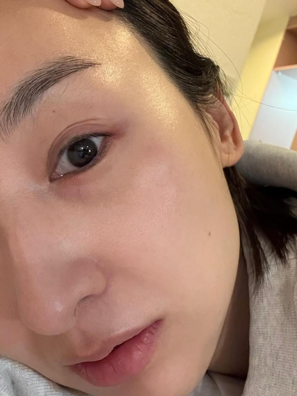 高海寧眼部周圍腫起，好似被人打。