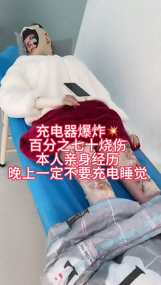 湖北女手機放枕邊通宵叉電，因充電器爆炸燒傷7成皮膚毀容。抖音＠依依的抗疤分享