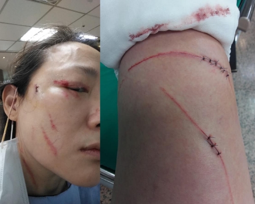台北一名女子因提醒鄰居戴口罩而遭對方斬傷，頭部及手臂均有多個傷口，血迹斑斑。 （女事主facebook）