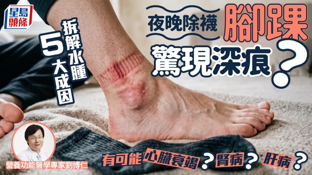 夜晚除襪腳踝驚現深痕？醫生拆解水腫5大成因 心臟衰竭/腎病/肝病也可能？