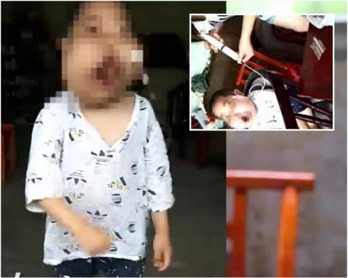 男童面部腫脹成有一張極像「河馬」的臉孔，只能靠一根導管注射流質食物維持生命（小圖）。網圖