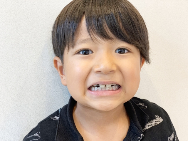 兒童箍牙︳小朋友適合箍牙嗎？（圖片來源：PhotoAC）