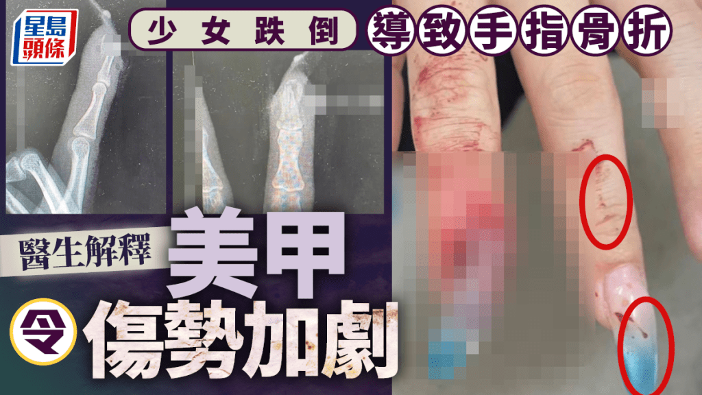 新年變靚D︱22歲少女跌倒手指骨斷裂流血   醫生：因做了美甲