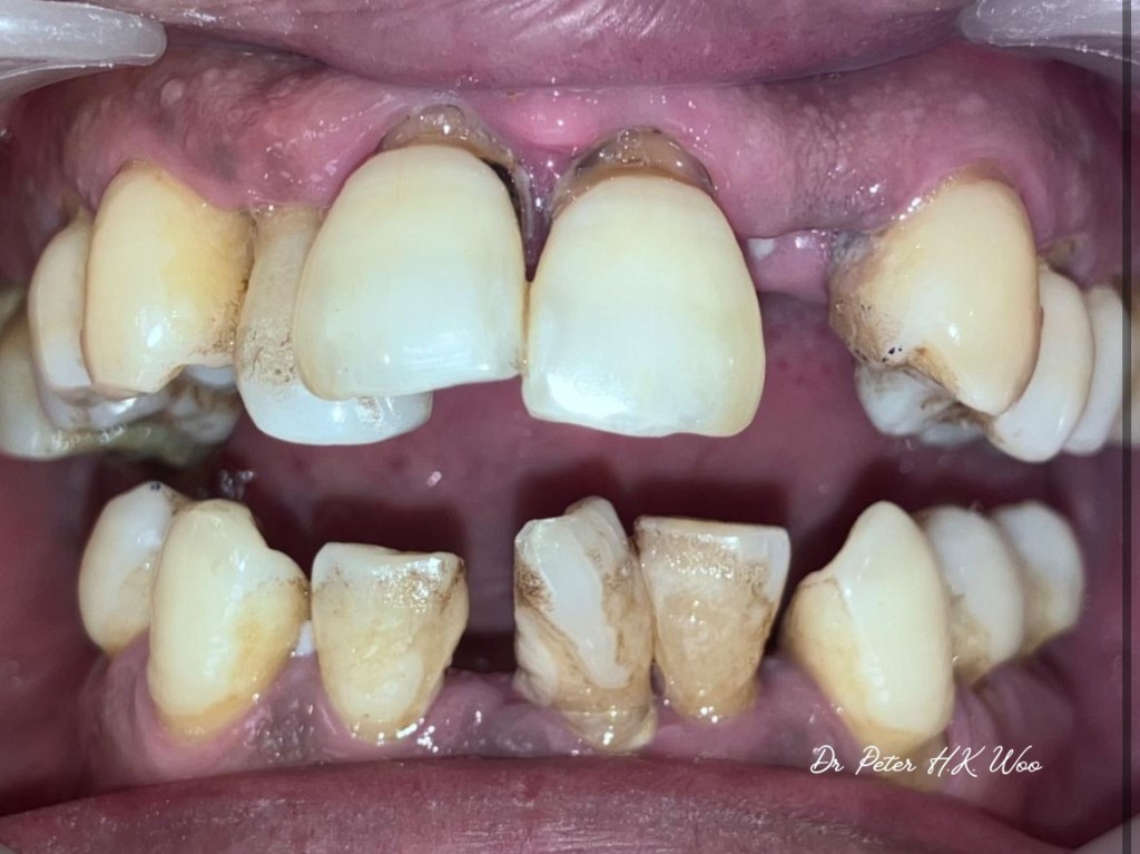 胡瀚鈞醫生分享另一宗牙周病病例，相片中的患者患有嚴重牙周病，而且有食煙習慣，有多隻缺牙，牙齒移位問題。（受訪者提供）