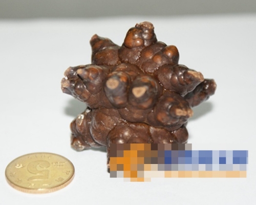 七旬老翁膀胱生「三尖八角」結石。網上圖片