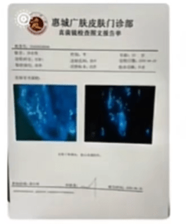 男事主脸部感染足癣。