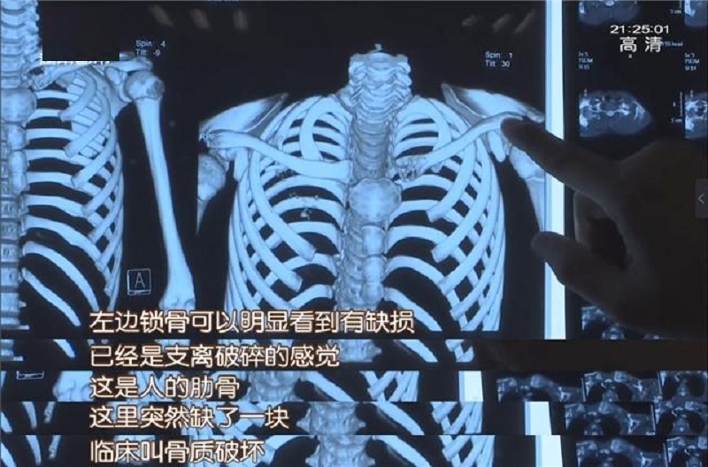 12歲的男童小家患上了肺癌末期,懷疑與生活習慣有關。網圖