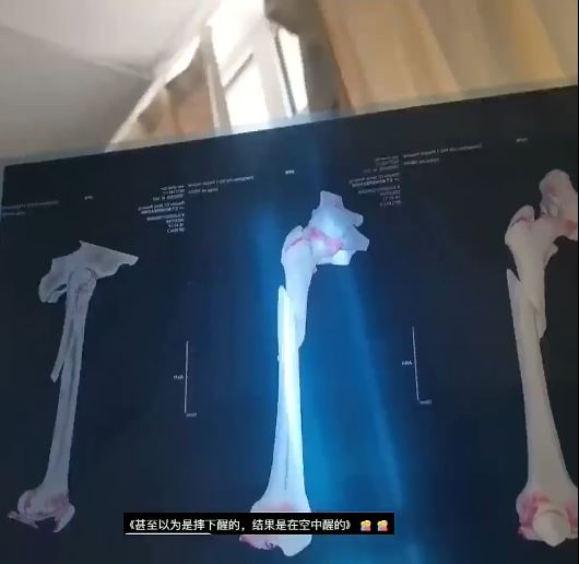 曹先生夢遊時由3樓墜下多處骨折。抖音