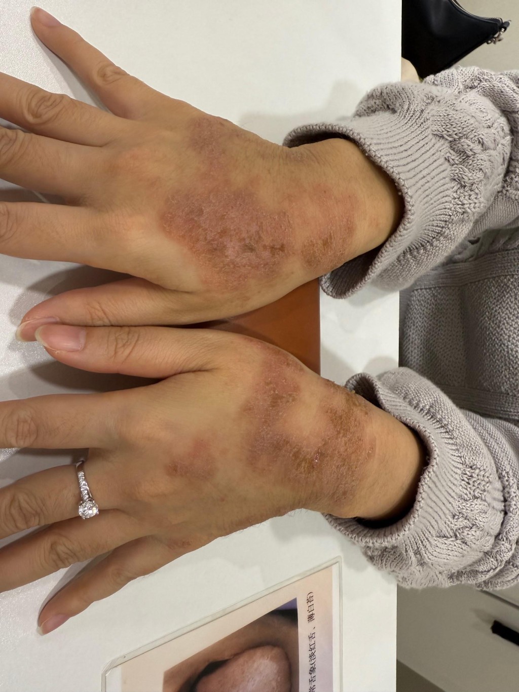 林女士饱受湿疹发作困扰半年，皮肤增厚、色素沉著，严重痕痒。（注册中医师陈嬿珺提供）