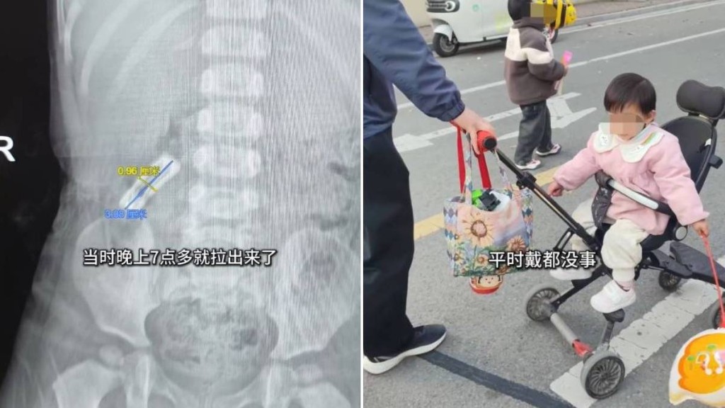 安徽有1歲女童誤吞3厘米長髮夾，靠食韭菜、金針菇成功排出體外。篝火視頻