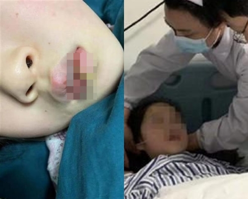 女童手上的竹籤硬生生插進頭顱內,並刺穿腦幹。網圖