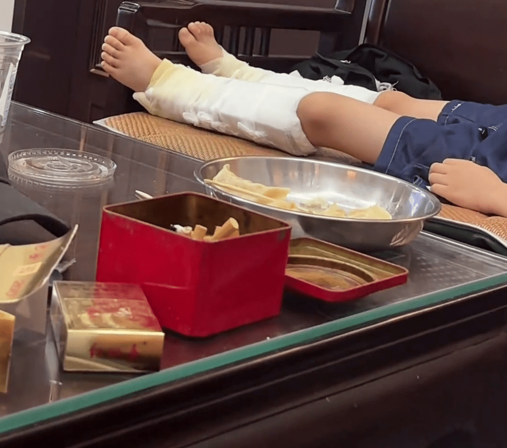 男童确诊为脚后跟骨折。