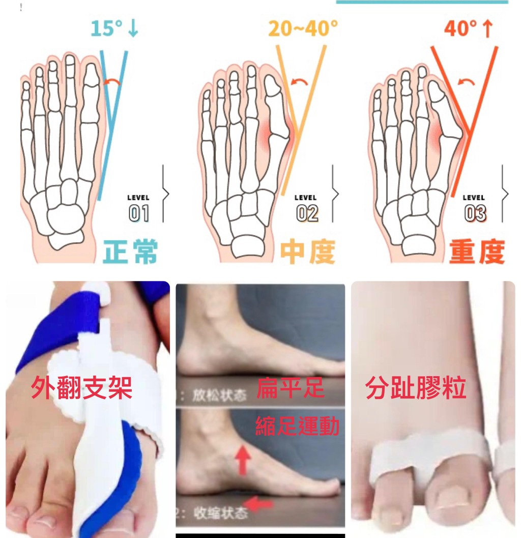 拇趾外翻腳掌不安定，全身骨骼關節便有代償變異。圖片由筆者提供