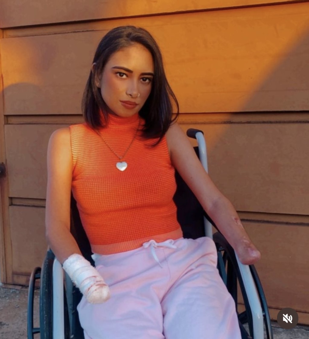 巴尔博萨（Gabrielle Barbosa）因患上尿道炎，感染扩散导致手脚全截肢。  Instagram@gabi_barbosaa1