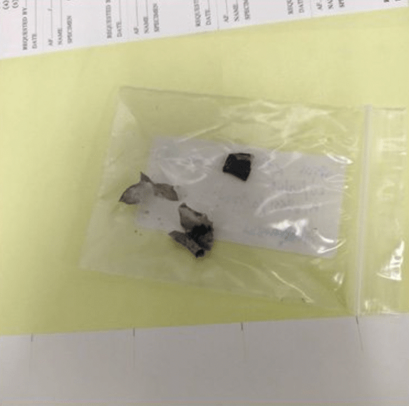 法醫在死者胸腔內發現三塊金屬碎片,確認全屬爆炸後的電子煙零件。Facebook@Drama-addict 法醫在死者胸腔內發現三塊金屬碎片,確認全屬爆炸後的電子煙零件。Facebook@Drama-addict