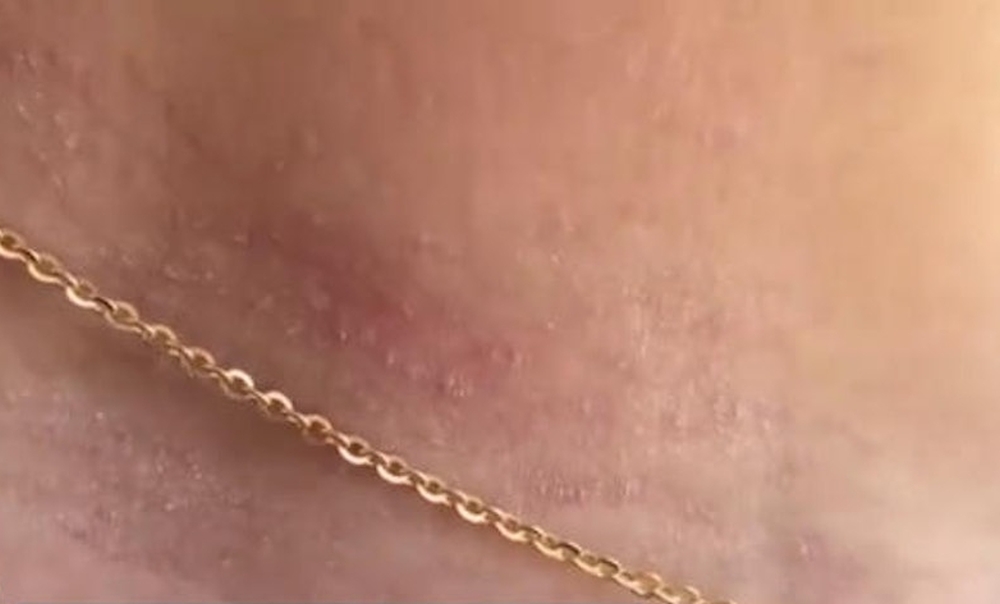 佩戴廉價首飾引發首飾性皮炎。 央視截圖