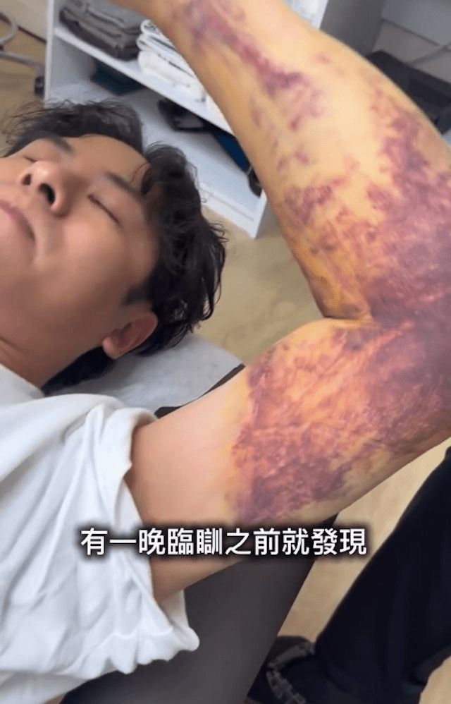 許廷鏗分享左手手術後的大片瘀青，腰間更因生蛇出現紅疹。