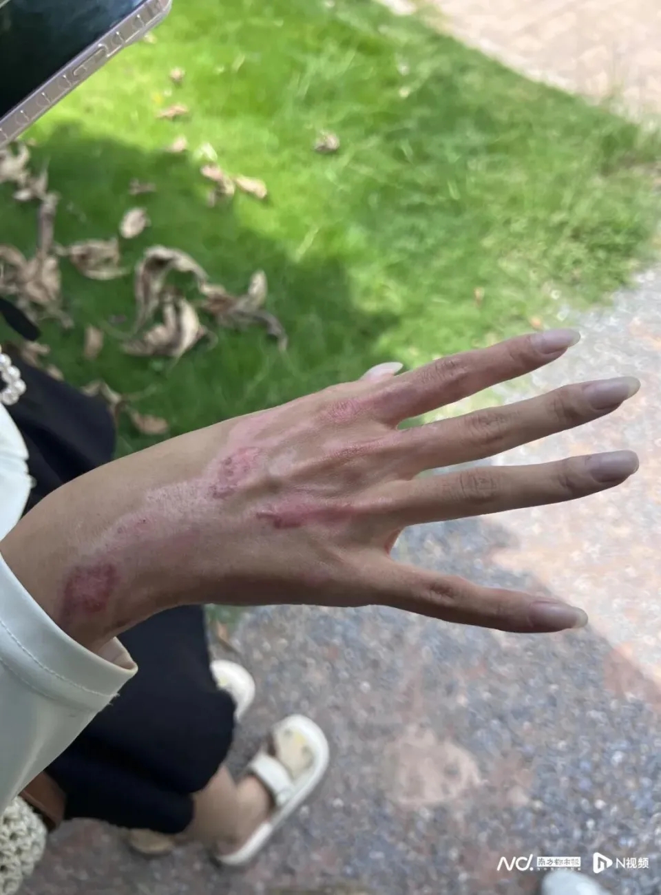 女博主发布伤情照片。 