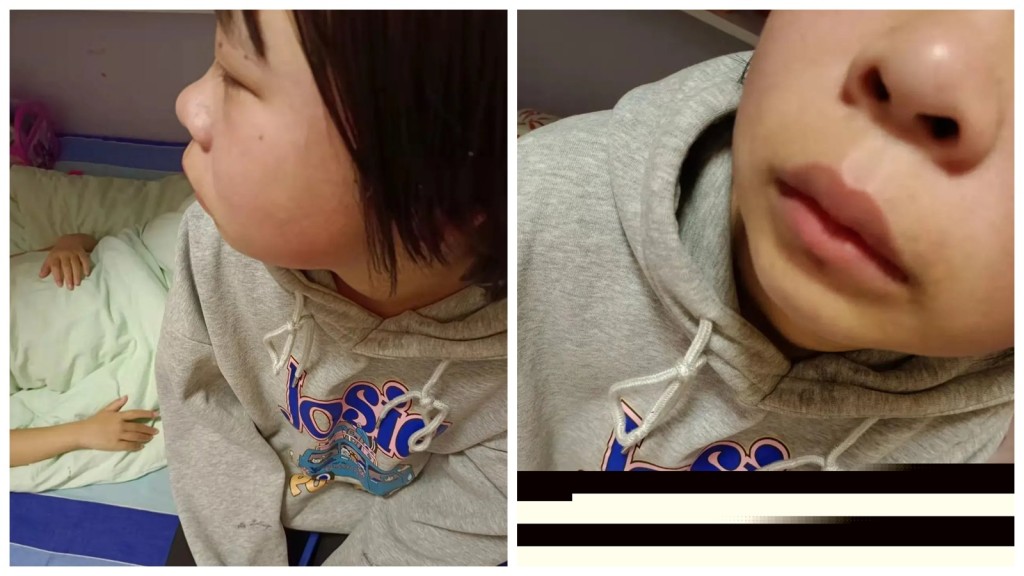 蘭蘭被打後臉部浮腫。互聯網圖片