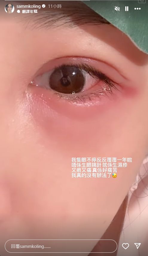 高海寧的眼肚位置又紅又腫。 高海寧的眼肚位置又紅又腫。