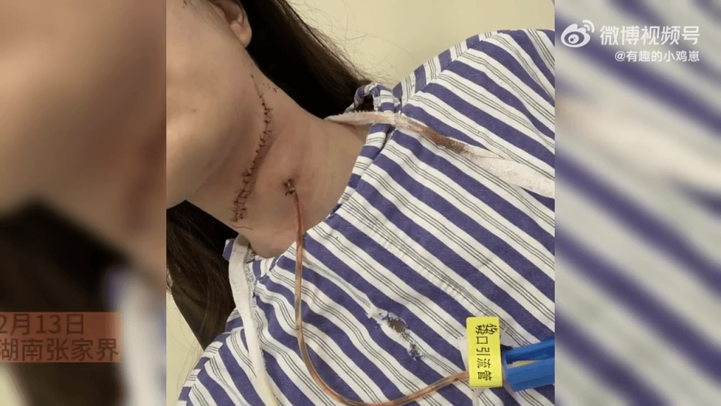 女子頸部有一條長達16厘米的傷口，插著一條管子。
