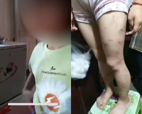 女童疑被父母長期施暴。網圖