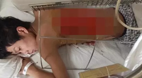 王福星將背部皮膚移植予兒子。網上圖片