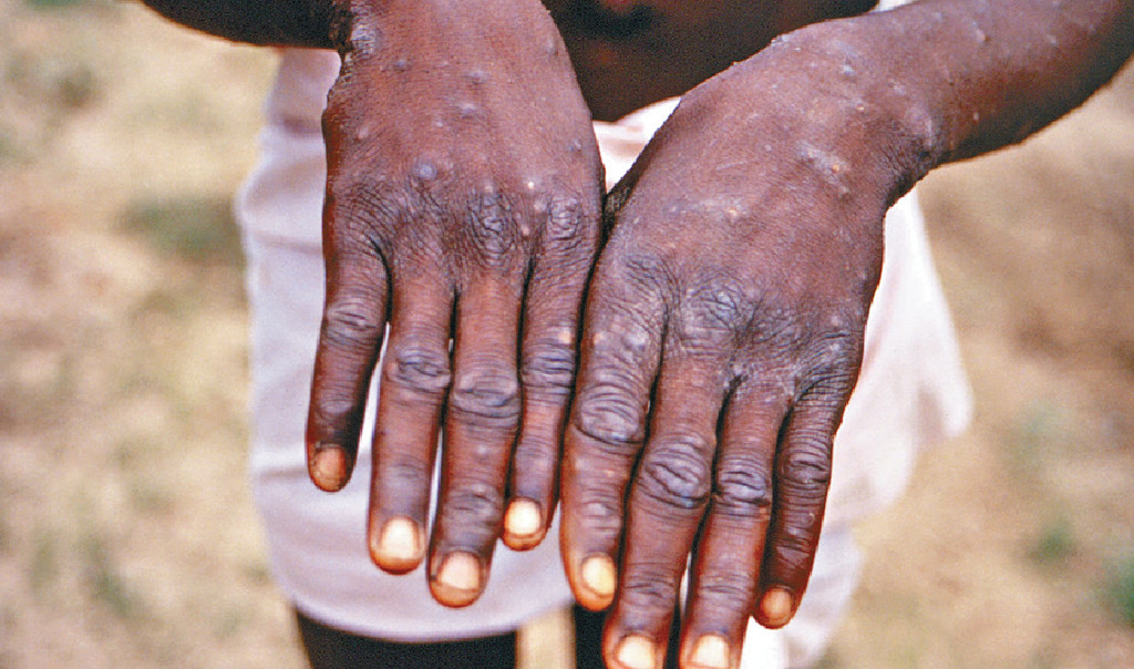 猴痘。AP資料圖片