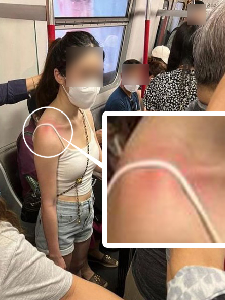 有网民追踪少女，发现在港铁内她的右侧肩膀有红肿，疑为侧背该装满避孕套的蓝色大购物袋所造成。