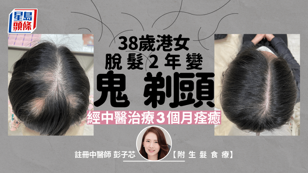 38歲港女脫髮2年變鬼剃頭，經中醫治療3個月後痊癒。