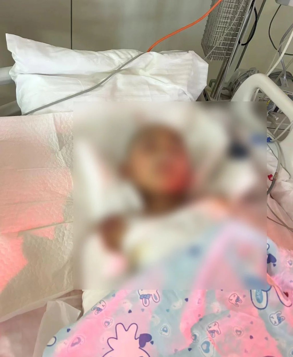 哈爾濱10歲男童遭兩惡犬咬成重傷，醫生指很大機會要截肢。