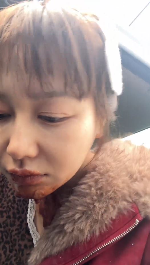 王添羽模仿喷火蛋糕遭回流火焰烧伤。抖音