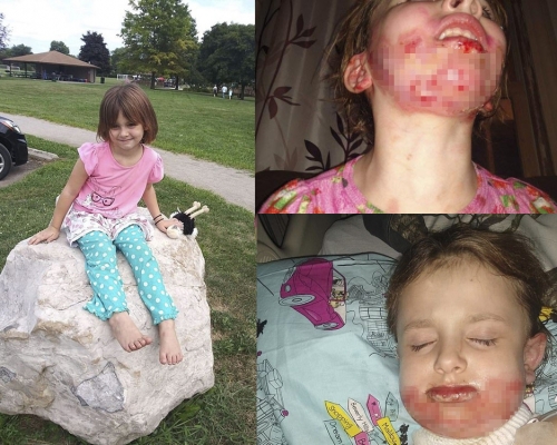 美國6歲小女孩用搓手液，同伴玩打火機造成搶火，女童臉部灼傷。