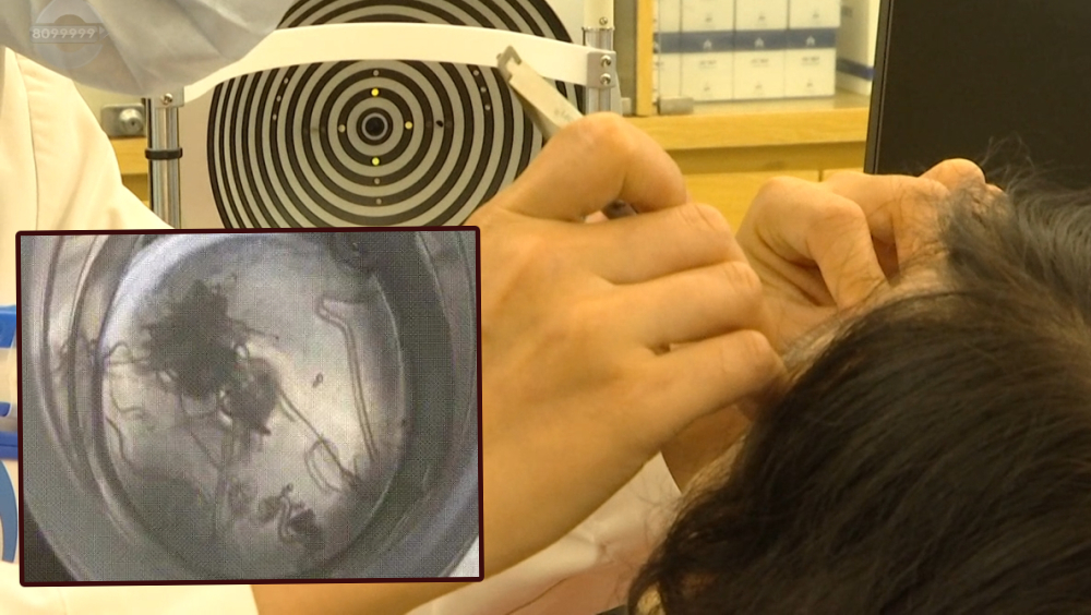 昆明女子雙眼藏60多條活生生寄生蟲，多到揉眼睛都掉出蟲。 