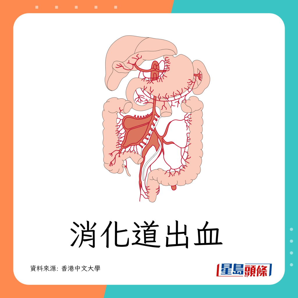 小腸癌｜小腸癌常見症狀 消化道出血