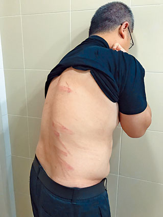 梁金成展示背部傷勢。