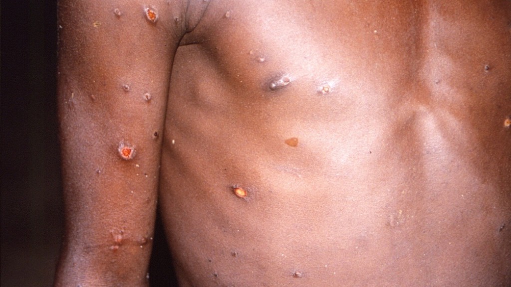 ​政府呼籲市民繼續提高警覺預防感染猴痘。路透社圖片