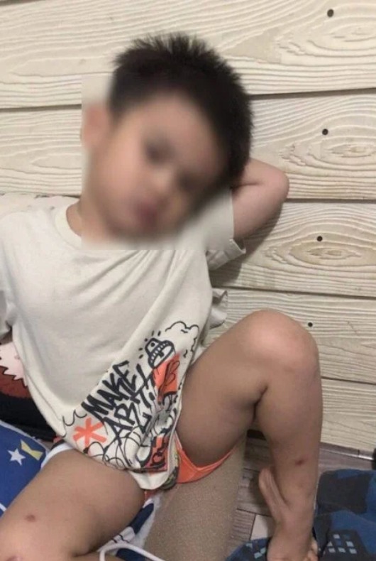 3歲男童普帕（Phupha）日前在繼父照顧期間突然死亡，生母一度聲稱兒子死於「癲癇發作」，惟法醫驗屍後揭發真相，證實男童遭硬物猛烈撞擊，導致小腸破裂及腹腔大量積血。facebook@อากาย