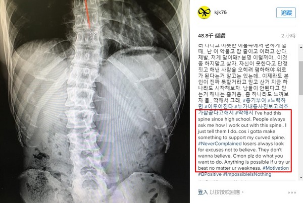 金鐘國曾在ig公開脊椎側彎的X光照。　